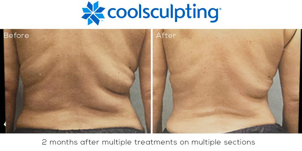 Fight back against cellulite with - Bioflect Medical